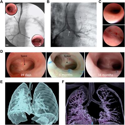 Advantages of FDM and gamma irradiation to manufacture personalized medical devices for airway obstructions